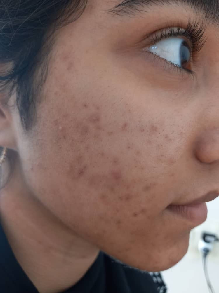 565 Melasmonil after treatment